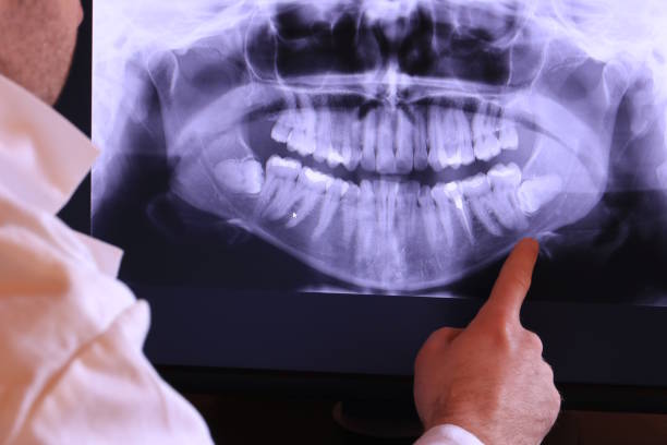 Best Emergency Dentist for Lost Fillings or Crowns in Cherryville, PA